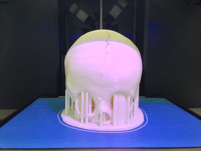 Skull model for craniofacial surgery planning ...
